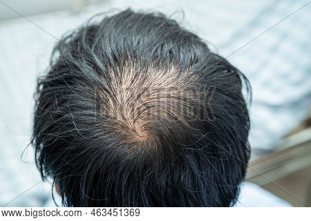 Bald In The Middle Head And Begin No Loss Hair Glabrous Of Mature Asian Business Smart Active Office