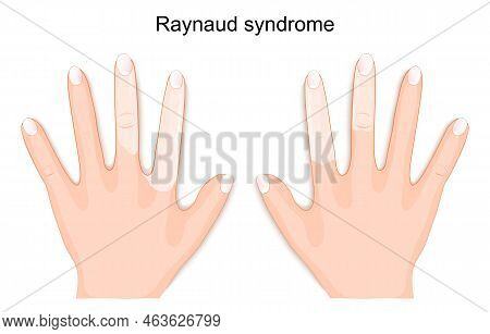Raynaud Syndrome. Hands Of A Person With Raynaud's Phenomenon During An Attack. Vector Illustration