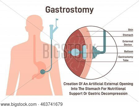 Gastrostomy. Gastric Inserted Feeding Tube, Food Nutritions Injecting