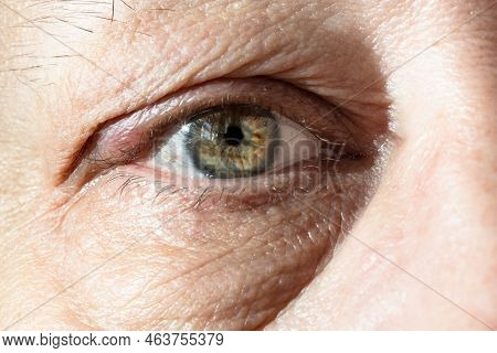 Male Eye With Thickening On Eyelid From Chalazion Closeup