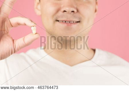 A Happy Smiling Man After Removing A Bad Tooth. A Man Holds A Molar In His Hands And Smiles, Close-u