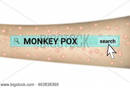 Monkey Pox Search On Blur Infected Hand. Illustration For Awareness About Monkey Pox Disease.