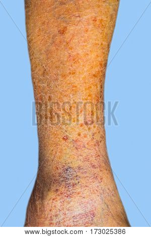Close-up of skin with varicose veins on senior male leg. Concept of dry skin