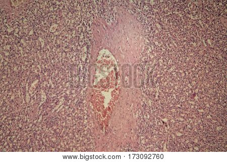 Cells of a human spleen with chronic myelogenous leukemia under the microscope.