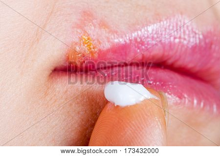 Herpes on the lip close-up macro. Woman lubricates the labial herpes ointment.