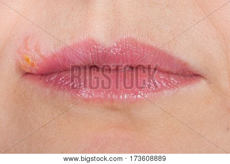 Herpes on the lip close up macro.