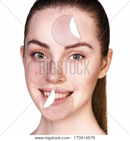 Circles layers of skin with acne unstick from good healthy skin of young woman.