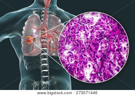 Lung Cancer, 3d Illustration And Photo Under Microscope. Histopathology Light Micrograph