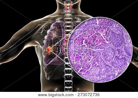 Lung Cancer, 3d Illustration And Photo Under Microscope. Light Micrograph Of Squamous Cell Carcinoma