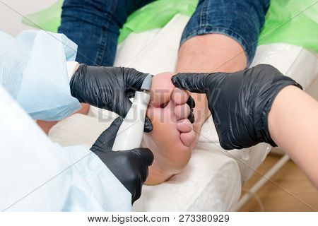 Podology Treatment. Podiatrist Treats Foot. Podiatry Doctor Or Dermatologist Treats The Patient In M
