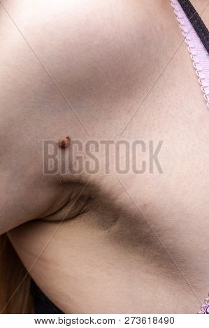 Unrecognizable Person Having Dark Fibroma, Dermatology Problem On Skin. Close Up Of Papilloma Dermat