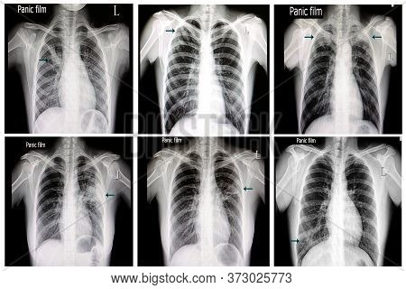 Collectiion Of Chest X-ray Film Of Patients With Pulmonary Tuberculosis.
