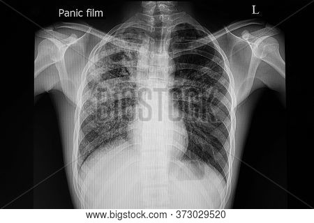 Xray Film Of A Patient With Active Pulmonary Tuberculosis In The Right Upper Lung