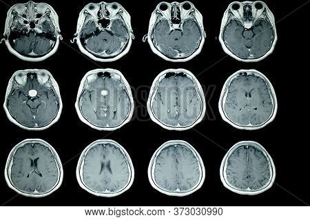 Mri Scan Of Patient Brain With Normal Signal Intensity Of The Brain Parenchyma