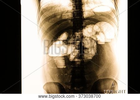Xray Film Of A Patient With Bowel Gas Pattern Showing Intestinal Ileus, Upright Position