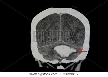 Ct Brain Scan Of A Stroke Patient With Massive Cerebellopontine Hemorrage