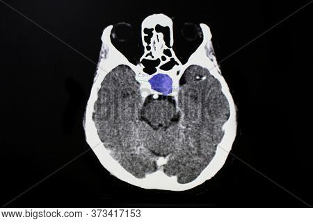 Ct Brain Scan Of A Patient With Pituitary Tumor Showing Heterogenous Mass In The Pituitary Fossa. Pi