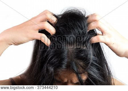 Women Head With Dandruff Caused By The Problem Of Dirty. Or Caused By Skin Disease Or Seborrheic Der