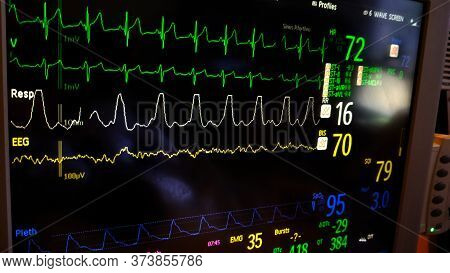 Ekg, Pulse, Bp And Respiration Icu Monitor Screen