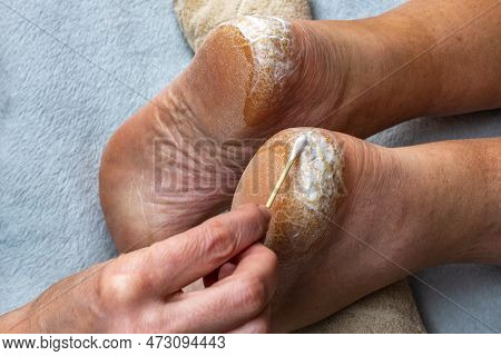 Heel With Dry Skin And Cracks. Medical Pedicure. An Orthopedic Doctor Applies A Healing Cream To The