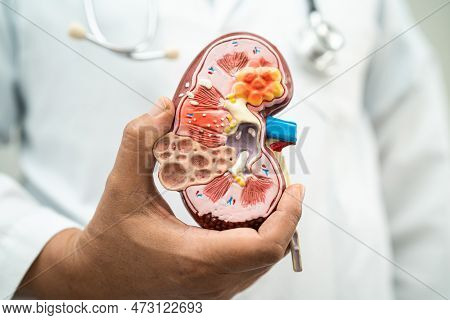 Kidney Disease, Chronic Kidney Disease Ckd, Doctor Hold Model To Study And Treat In Hospital.