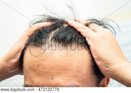 Bald At Front Of Head And Begin No Loss Hair Glabrous Of Mature Asian Business Smart Active Office M