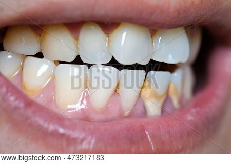 Tooth's A Man Smoking Bad. Man Smokes A Cigarettes Have Tooth Decay And Calculus On Teeth, So We Sho