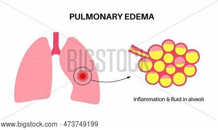 Pulmonary Edema Anatomical Poster. Abnormal Fluid In Lungs. Inflammation In The Human Respiratory Sy