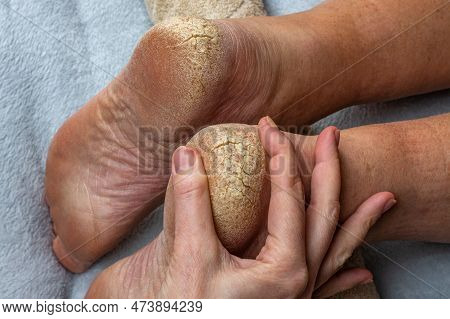 Cracks On The Heels Of A Persons Foot, Foot Health Problems, Neglected Heel Of A Person. A Doctor Ex