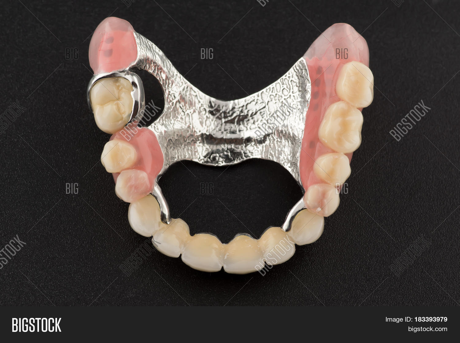 Сотрудники базиса. Протез с металлическим базисом. Металлизированный Базис съемных пластиночных протезов. Пластиночный протез с металлическим базисом. Бюгельный протез замковый (2 замка Bredent).