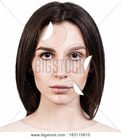 Circles layers of skin with acne unstick from good healthy skin of young woman.