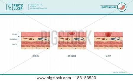 Stomach erosion and peptic ulcer stages infographic: stomach lining and mucosa cross section diagram medical illustration