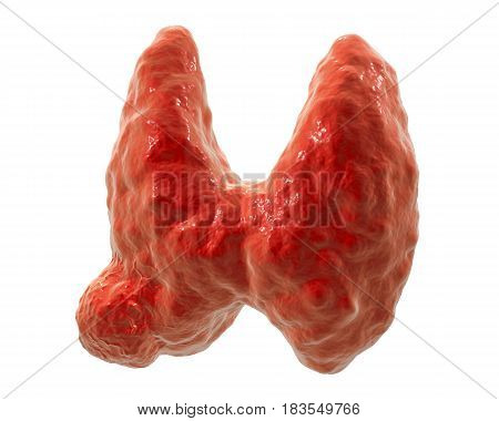Thyroid cancer. 3D illustration showing thyroid gland with tumor isolated on white background