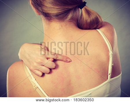 Woman Scratching Her Itchy Back With Allergy Rash