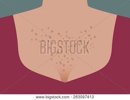 Skin Aging, Spots On Body, Neckline, Protects Skin From Sunburn, Pigmentation On Chest, Freckles On 