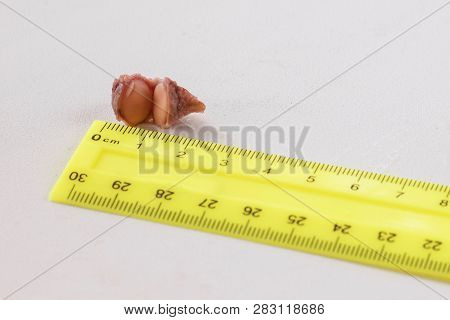 Cut Out Fibroma, Mole For Microscopic Examination, White Background, Close-up, Biopsy