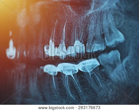 Dental Xray For All Teeth, Side View