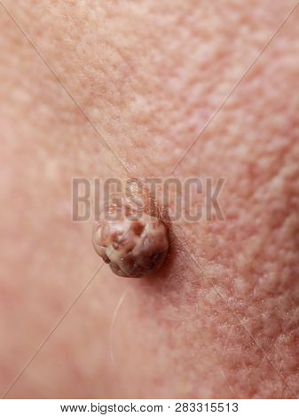 Details Of Senior Woman Face. Elderly Pensioner Female, Dermal Fibroma Close Up.