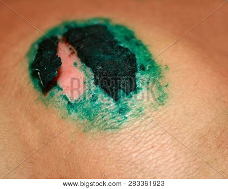 Healing Wound On The Knee. The Wound Treated With Brilliant Green. The Scab Will Climb