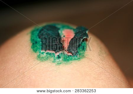 Healing Wound On The Knee. The Wound Treated With Brilliant Green. The Scab Will Climb