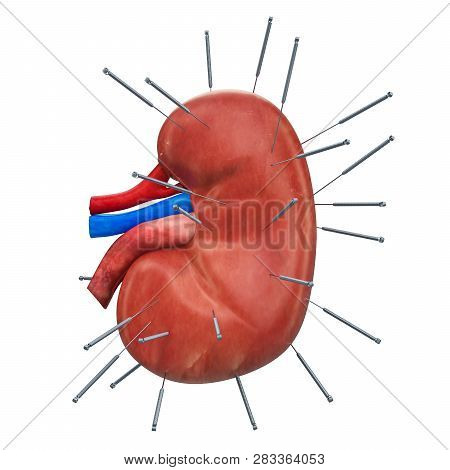 Human Kidney With Acupuncture Needles. Acupuncture Treatment Of Kidney Concept, 3d Rendering Isolate