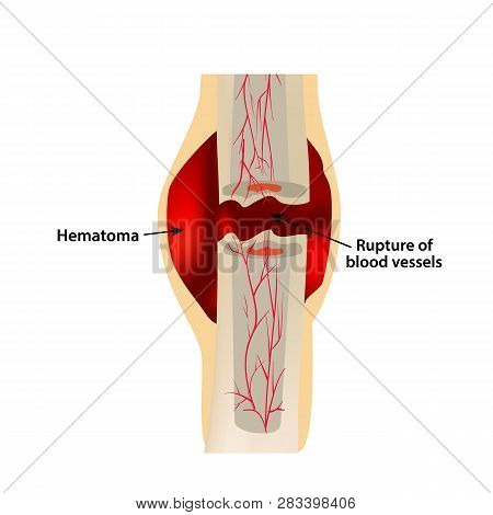 1 Stage Of Healing Bone Fracture. Formation Of Callus. Hematoma. The Bone Fracture. Infographics. Ve