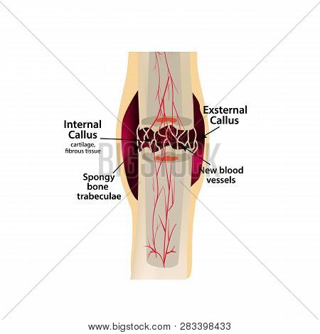 2 Stage Of Healing Bone Fracture. Formation Of Callus. The Bone Fracture. Infographics. Vector Illus