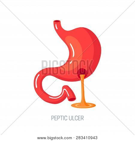 Gastric Acid Pours Out Of Peptic Ulcer. Sick Stomach Concept. Vector Illustration In Flat Style.