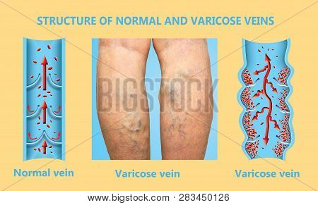 Varicose Veins On A Female Senior Legs. The Structure Of Normal And Varicose Veins. Concept Of Dry S