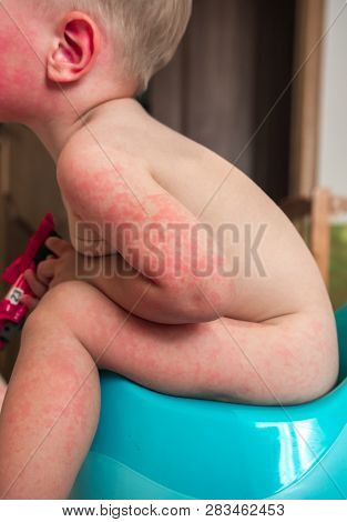 Allergies, Pimples On The Baby's Skin. Food Allergy.