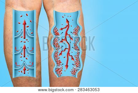 Varicose Veins On A Female Senior Legs. The Structure Of Normal And Varicose Veins. Concept Of Dry S