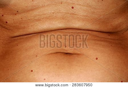 The Abdomen Is In Red Angiomas. Flabby Wrinkled Abdomen. The Navel Is Stretched.