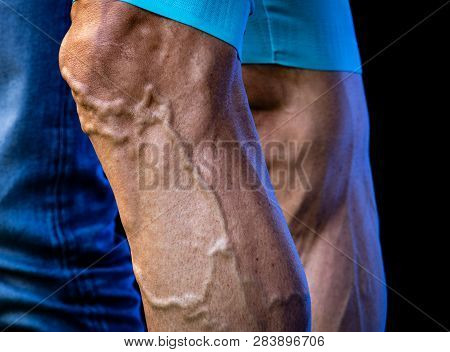 Cyclist Legs With Varicose And Protruded Veins