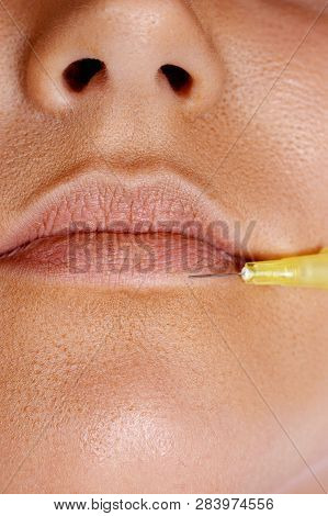 Injection Of Botox In Female Lips And Holding Syringe. Closeup Of Procedure To Lip Augmentation.  Co